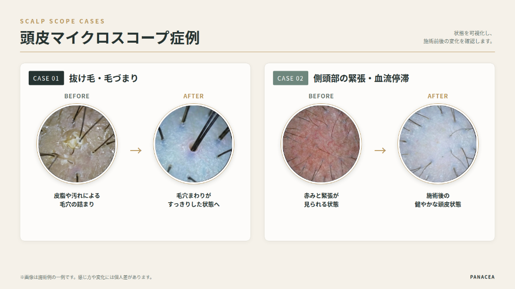 頭皮マイクロスコープ症例（抜け毛・毛づまり・側頭部の緊張・血流停滞の改善）